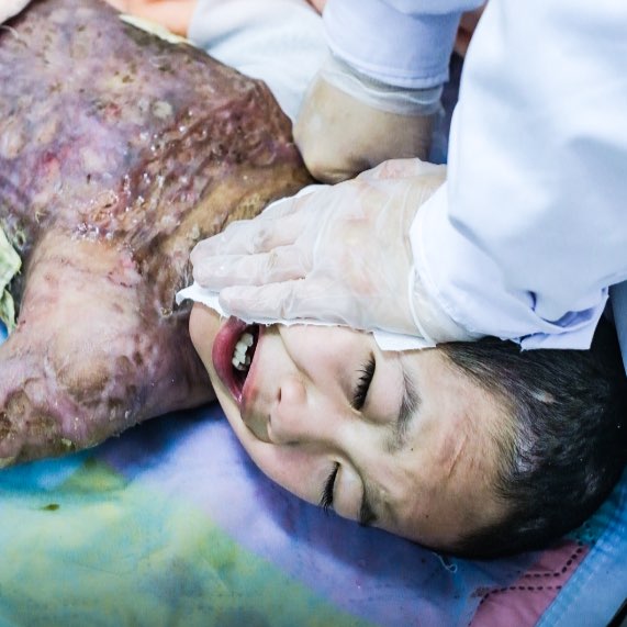 Urgent! Helping Children With Deep Burns