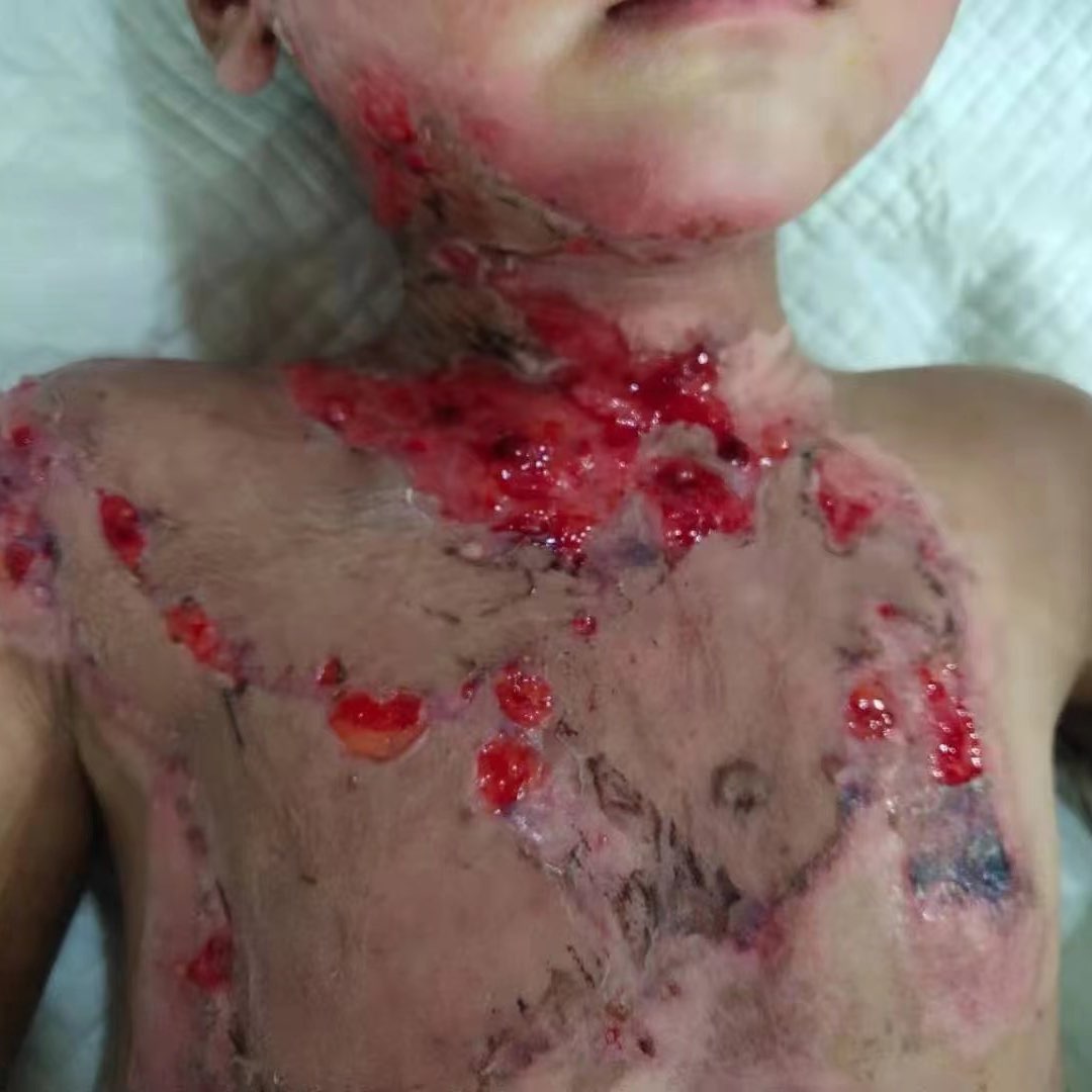 Urgent! Helping Children With Deep Burns